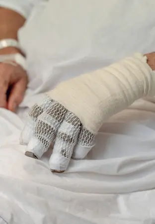 Burn Injury - illustration
