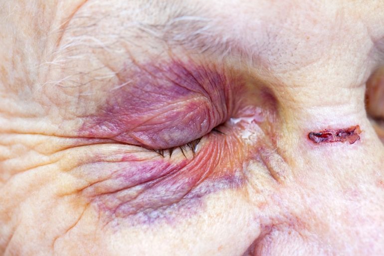 nursing home abuse